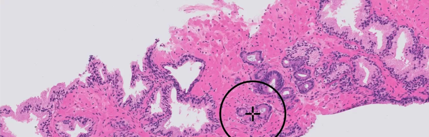 Paige Prostate is designed to identify areas in pathology images that may indicate prostate cancer. / PAIGE. AI INC.