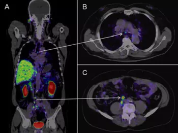 Example of PSMA Imaging in a prostate cancer patient