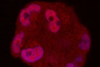 An image of prostate cancer cell under a microscope