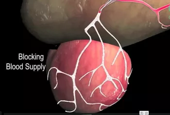New BPH treatment for prostate cancer