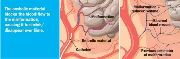 The  embolic material blocks the blood flow to the malformation, causing it to shrink or disappear over time