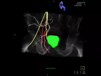 Image of digital mapping of vessels for planning and guidance of embolization. Courtesy of Siemens Healthineers