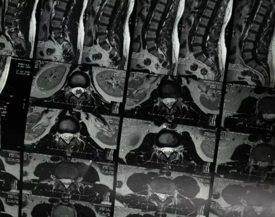 bone scans