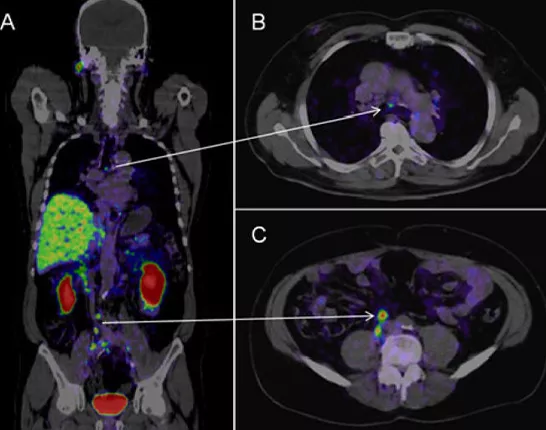 Example of PSMA Imaging for prostate cancer