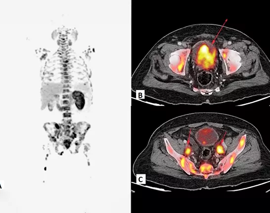 Example of PSMA PET Imaging for prostate cancer