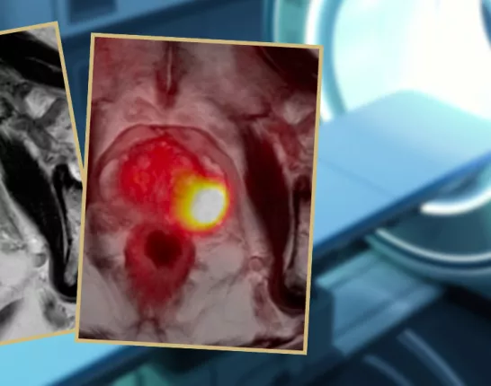 MRI scan with two images of a prostate overlaid