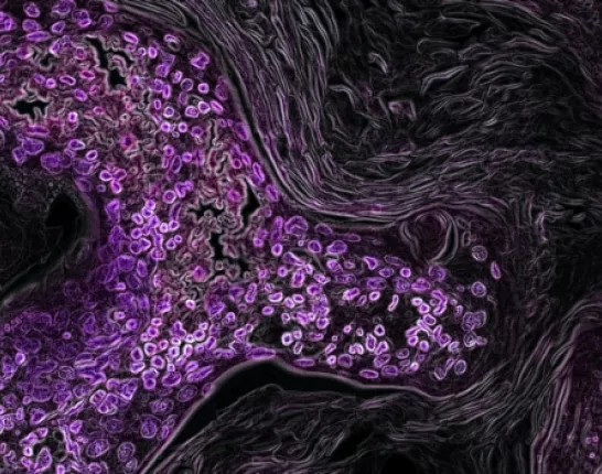 Lung Cancer Cells