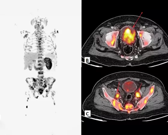 Example of PSMA PET Imaging for prostate cancer