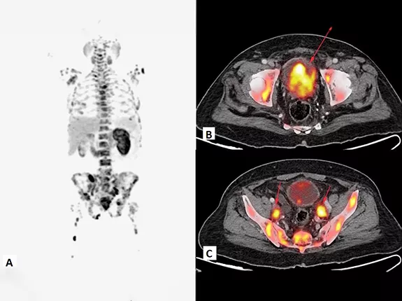 Example of PSMA PET Imaging for prostate cancer