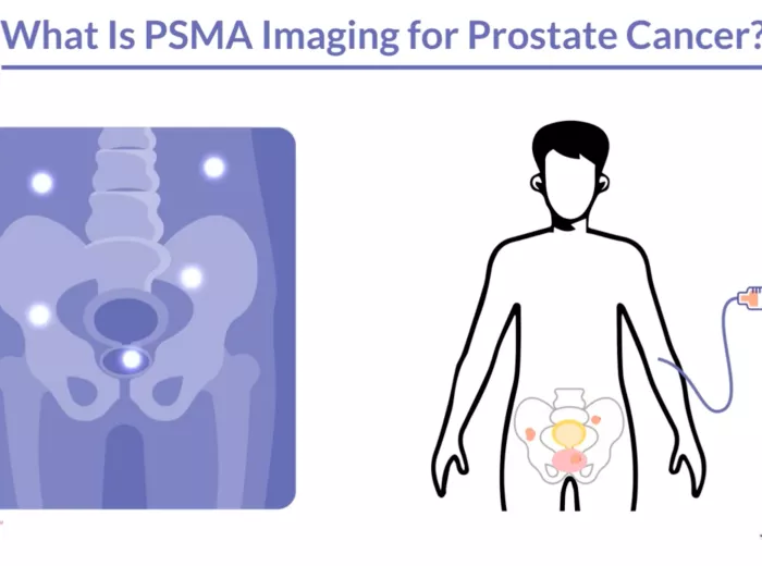 What Is PSMA Imaging? Video Still