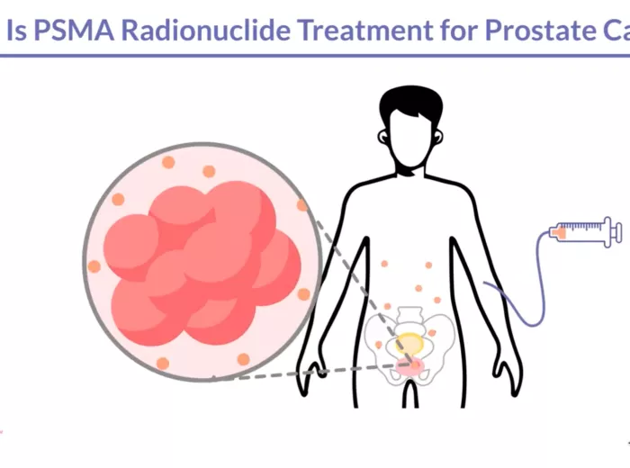 What is PSMA Radionuclide Treatment? Video Still