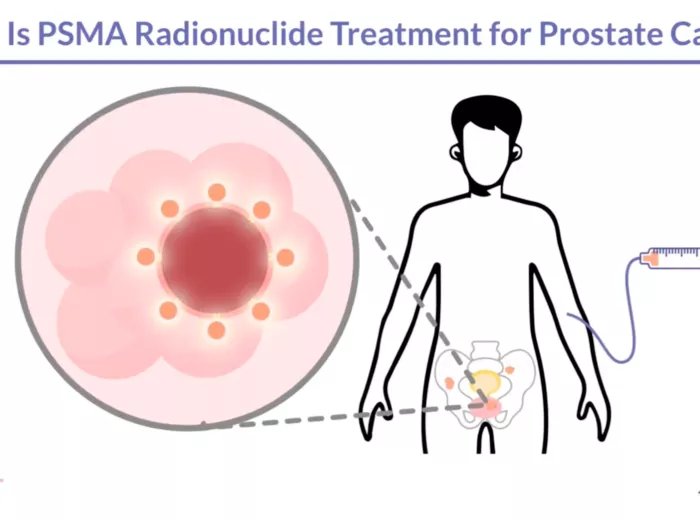 What is PSMA Radionuclide Treatment? Video Still