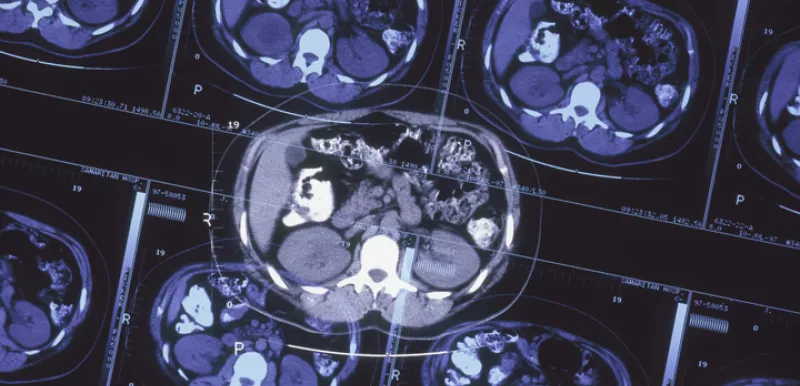 X-ray Treatments of Seizures