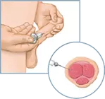 A drawing of an injection for treating erectile dysfunction