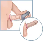 A drawing of a vacuum device for treating erectile dysfunction