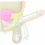 A drawing of a penile implant for treating erectile dysfunction