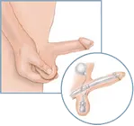 A drawing of a penile implant for treating erectile dysfunction