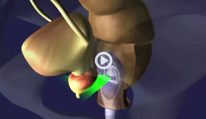 HIFU zaps prostate cancer