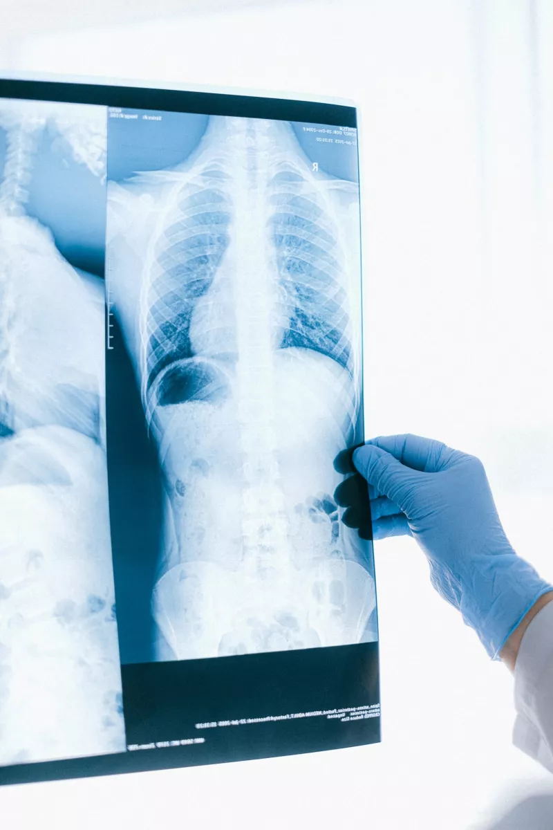 X-ray of a man's torso