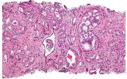 A tissue sample that might be used by a pathologist to diagnose cancer