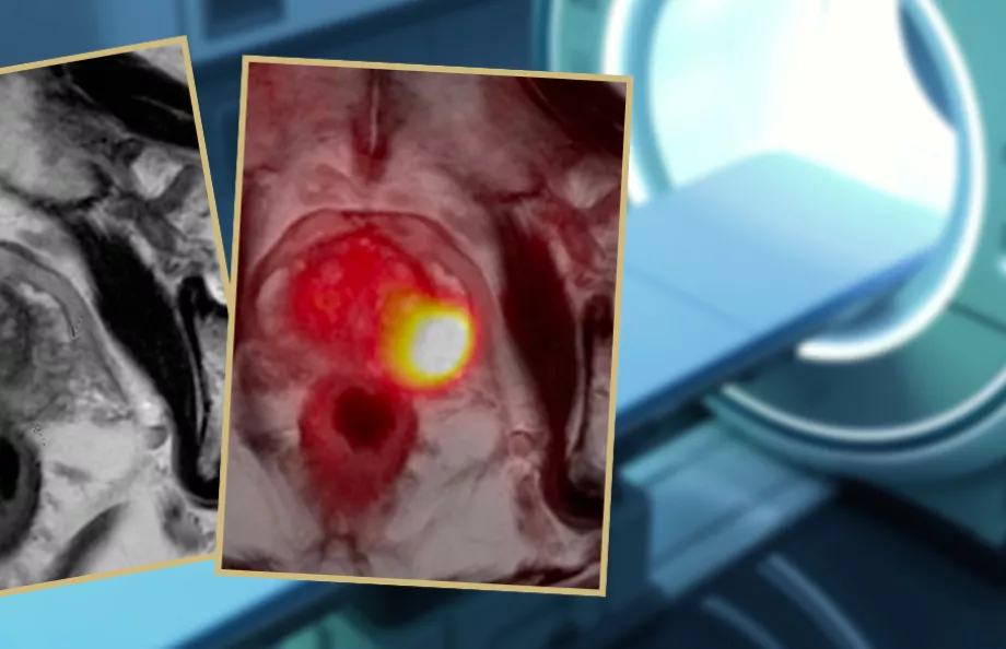 MRI scan with two images of a prostate overlaid